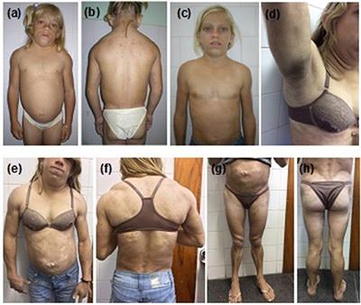 Homozygous and Heterozygous Nuclear <mark class="highlighted">Lamin A</mark> p.R582C Mutation: Different Lipodystrophic Phenotypes in the Same Kindred